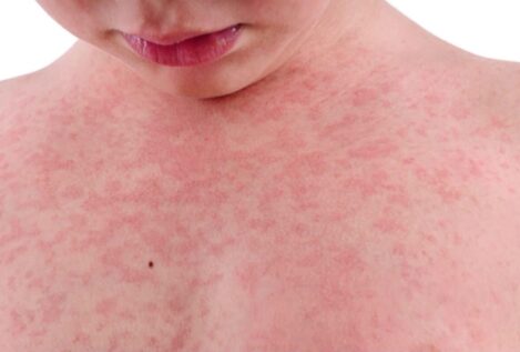 Cuando el metal hiere: guía para la prevención de la dermatitis de contacto