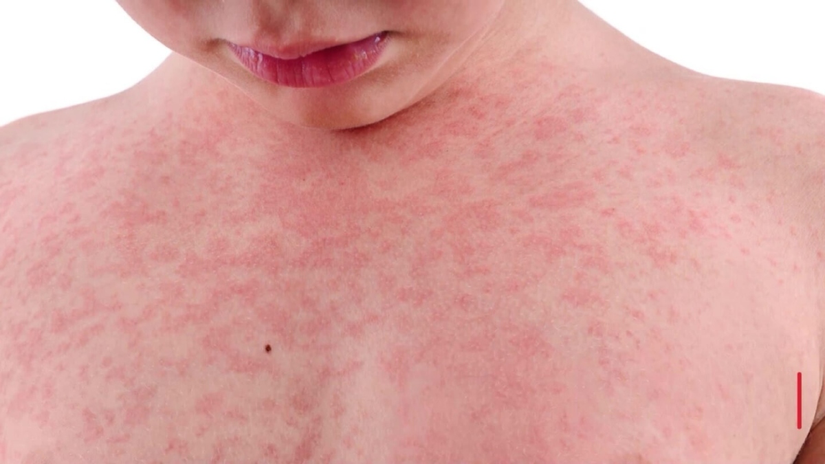 Cuando el metal hiere: guía para la prevención de la dermatitis de contacto