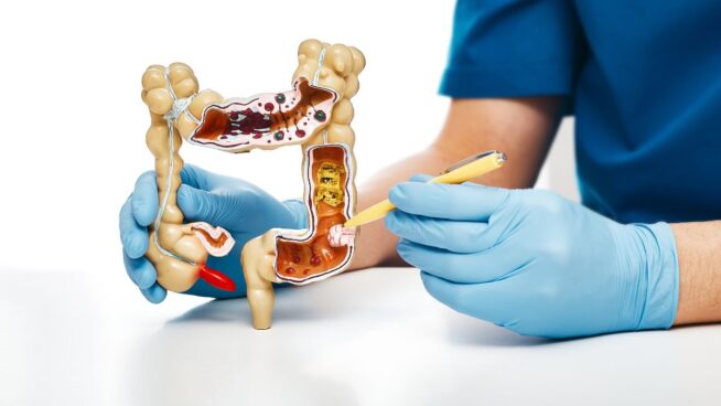 Los siete síntomas del cáncer de colon en mujeres