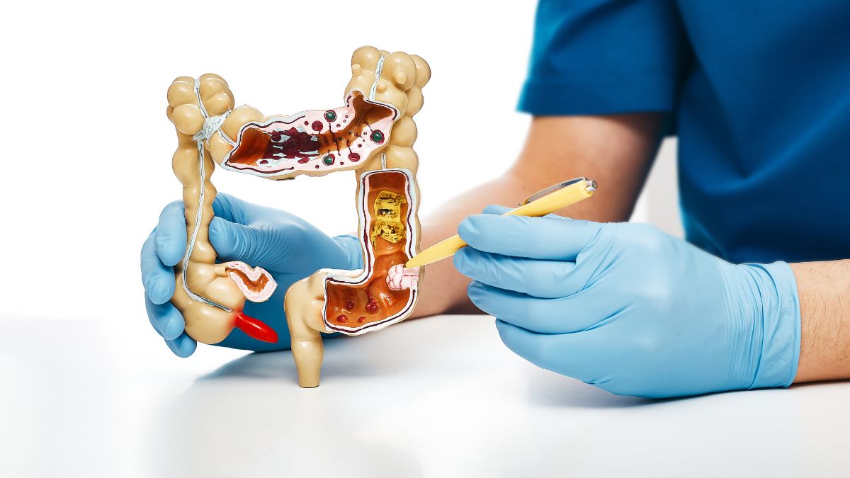 Los siete síntomas del cáncer de colon en mujeres