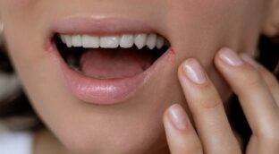 La misteriosa relación entre los herpes y el alzhéimer