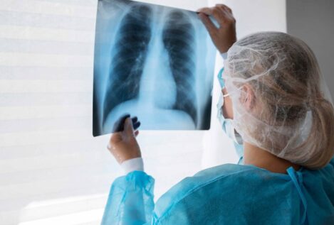 Identifican una nueva diana terapéutica para el cáncer de pulmón