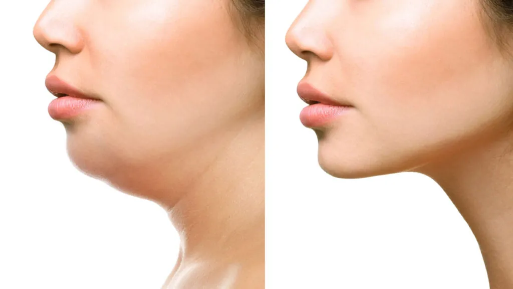 Antes y después de un lifting de cuello. (Fuente: IEMEC Clinic)