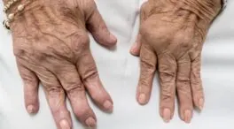 Síntomas de artritis reumatoide en mujeres: señales que requieren atención inmediata