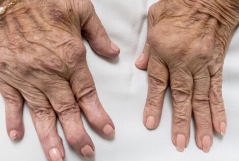 Síntomas de artritis reumatoide en mujeres: señales que requieren atención inmediata