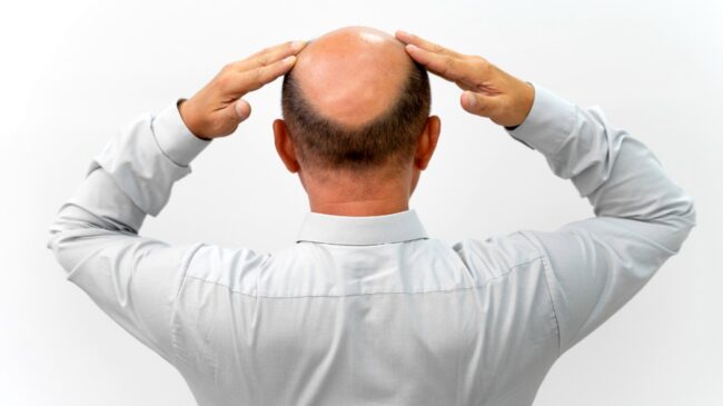 España, el país con más calvos de Europa: qué podemos hacer (según la ciencia) para evitarlo