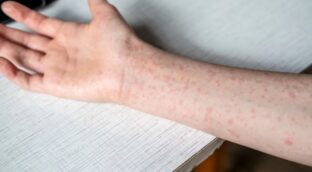 Sarampión: ¿cómo hacer frente al aumento del número de casos?