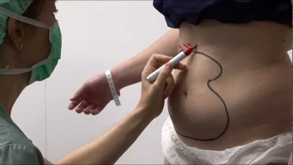 Preparativo para un lipofilling corporal con grasa. (Fuente: Dr. Nadir Salalues Hurtado)