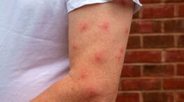 Los mejores remedios caseros para picaduras de mosquitos, según Medical News Today