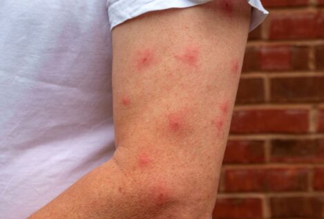 Los mejores remedios caseros para picaduras de mosquitos, según Medical News Today