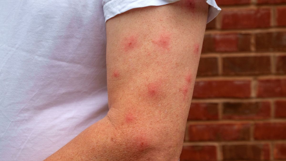 Los mejores remedios caseros para picaduras de mosquitos, según Medical News Today