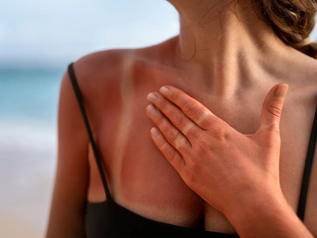 El callo solar consiste en quemarse a propósito la piel. (Fuente: Shutterstock)