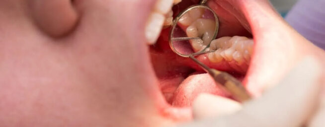 La evolución de nuestras mandíbulas explica por qué tenemos dientes más juntos que nunca