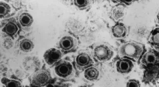 Descubren un antiviral contra el herpes que vence la resistencia a las curas actuales