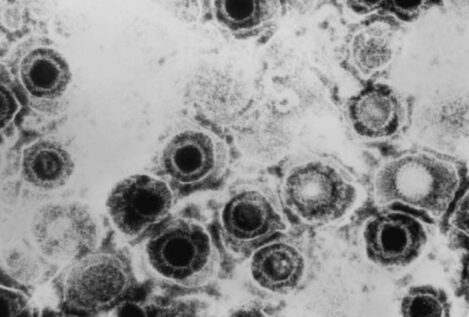 Descubren un antiviral contra el herpes que vence la resistencia a las curas actuales