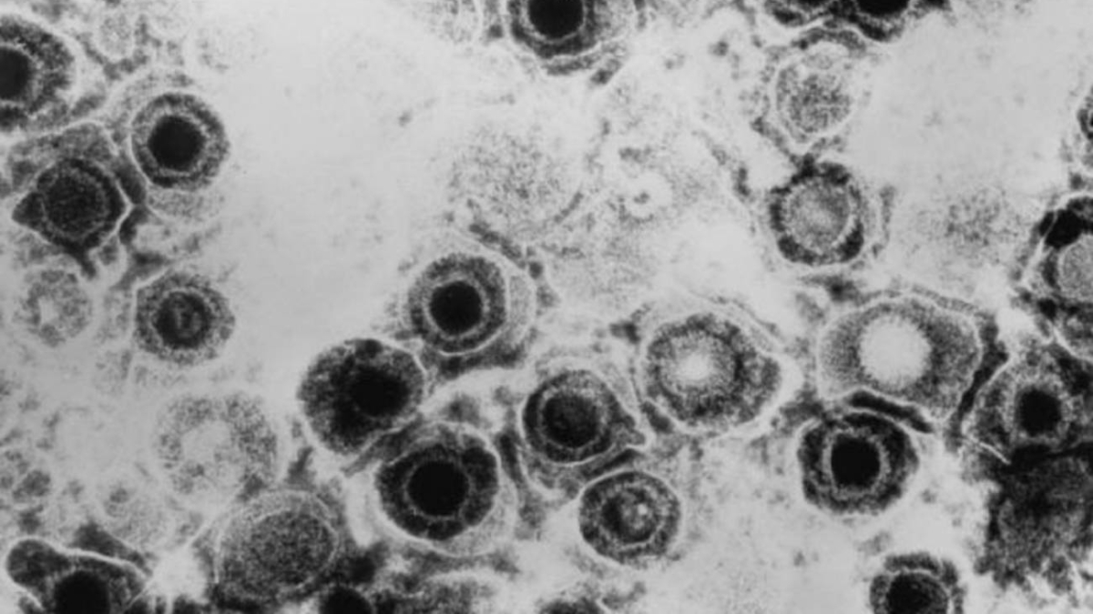 Descubren un antiviral contra el herpes que vence la resistencia a las curas actuales