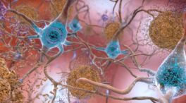 El alzhéimer, ¿una enfermedad infecciosa?