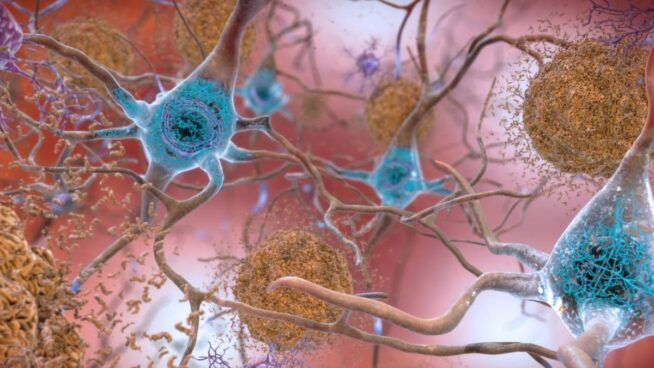 El alzhéimer, ¿una enfermedad infecciosa?
