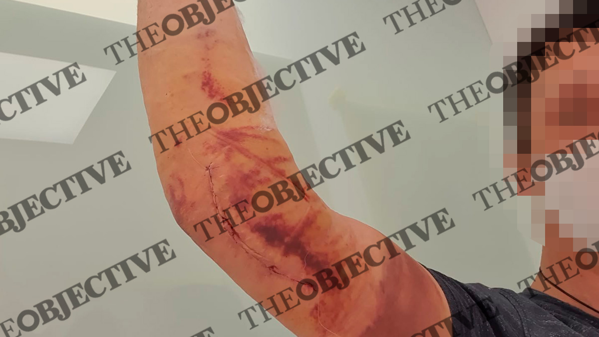 Interior no ha reconocido aún la incapacidad del policía al que agredieron los indultados anti-Vox