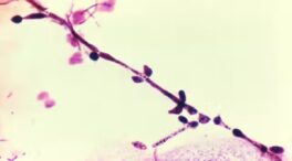 ¿Por qué la candidiasis vaginal continúa siendo un problema médico tan frecuente?