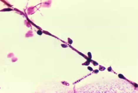 ¿Por qué la candidiasis vaginal continúa siendo un problema médico tan frecuente?