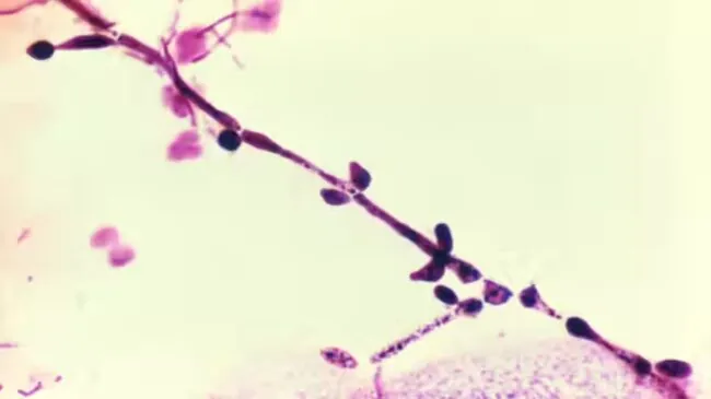 ¿Por qué la candidiasis vaginal continúa siendo un problema médico tan frecuente?