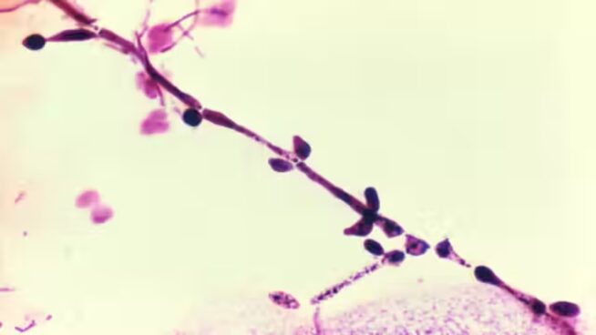 ¿Por qué la candidiasis vaginal continúa siendo un problema médico tan frecuente?