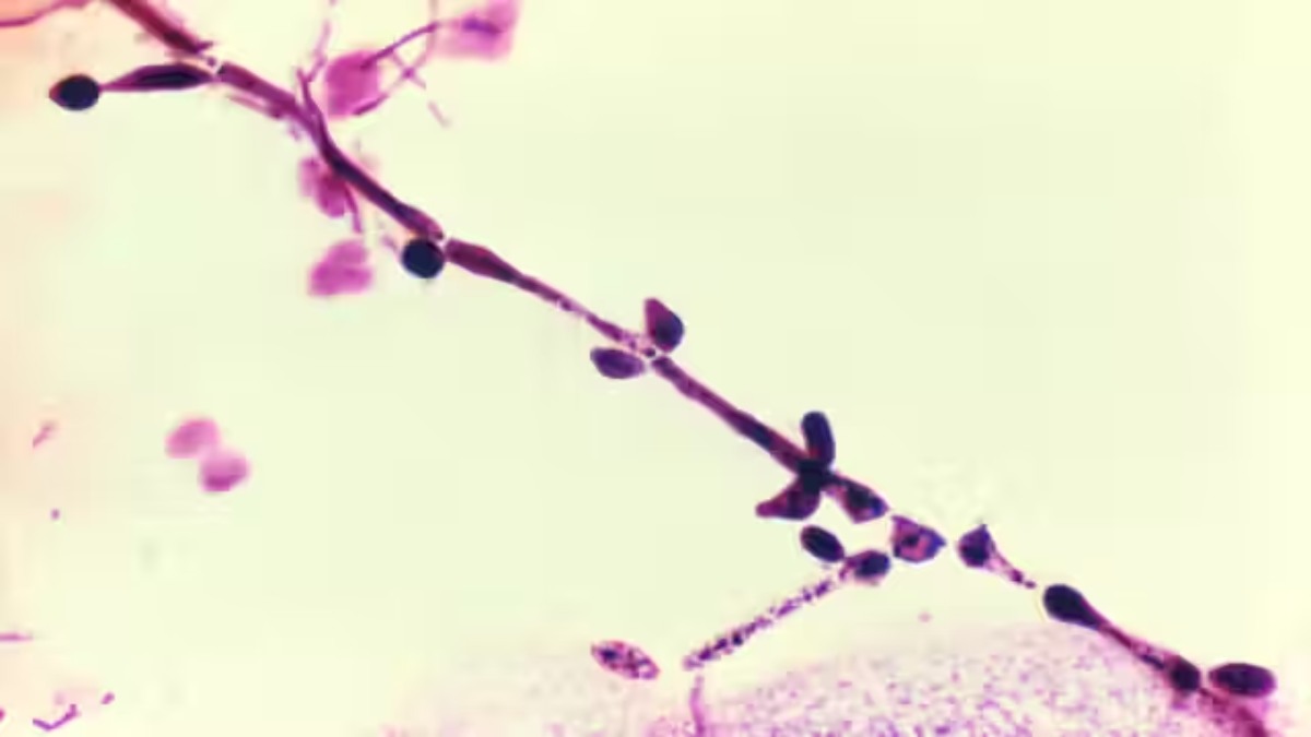 ¿Por qué la candidiasis vaginal continúa siendo un problema médico tan frecuente?