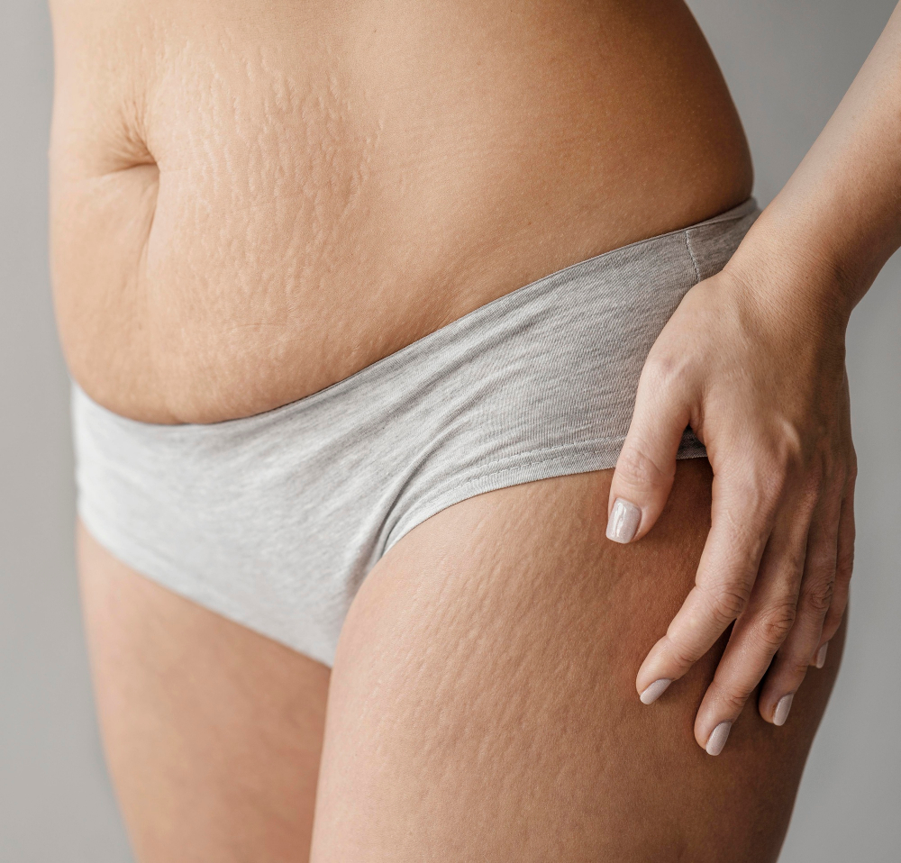 Cuerpo con estrías. (Fuente: Freepik)