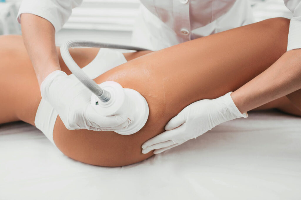Tratamiento láser para las estrías. (Fuente: SkinCenter)