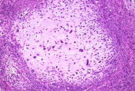 Un estudio refuerza un fármaco contra el cáncer de mama que actúa como un caballo de Troya