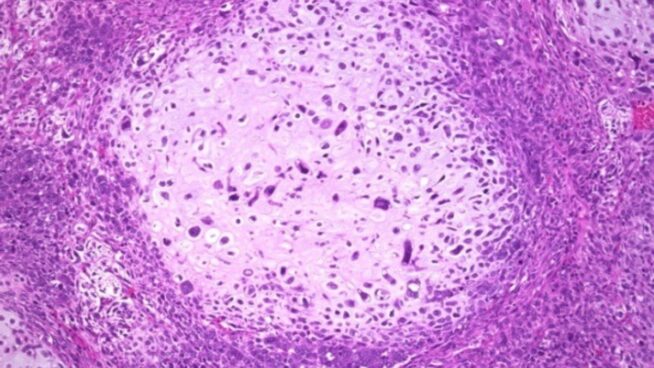 Un estudio refuerza un fármaco contra el cáncer de mama que actúa como un caballo de Troya
