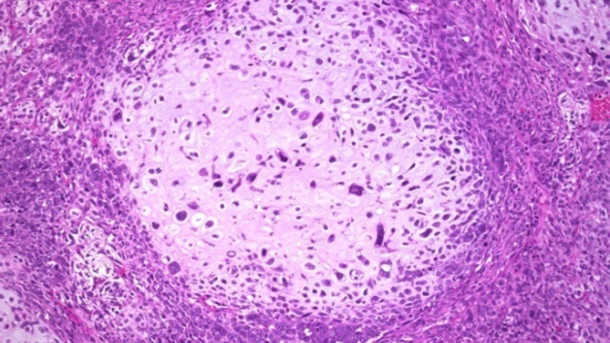 Un estudio refuerza un fármaco contra el cáncer de mama que actúa como un caballo de Troya