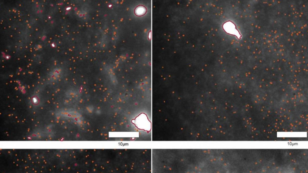 Observan por primera vez las ‘primeras huellas’ del párkinson en tejido cerebral