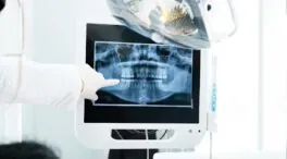 ¿La caries avanza o se detiene? Cómo evitar que despierten las lesiones inactivas
