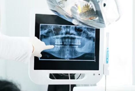 ¿La caries avanza o se detiene? Cómo evitar que despierten las lesiones inactivas