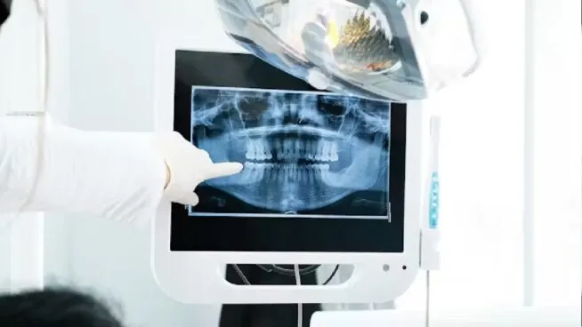 ¿La caries avanza o se detiene? Cómo evitar que despierten las lesiones inactivas