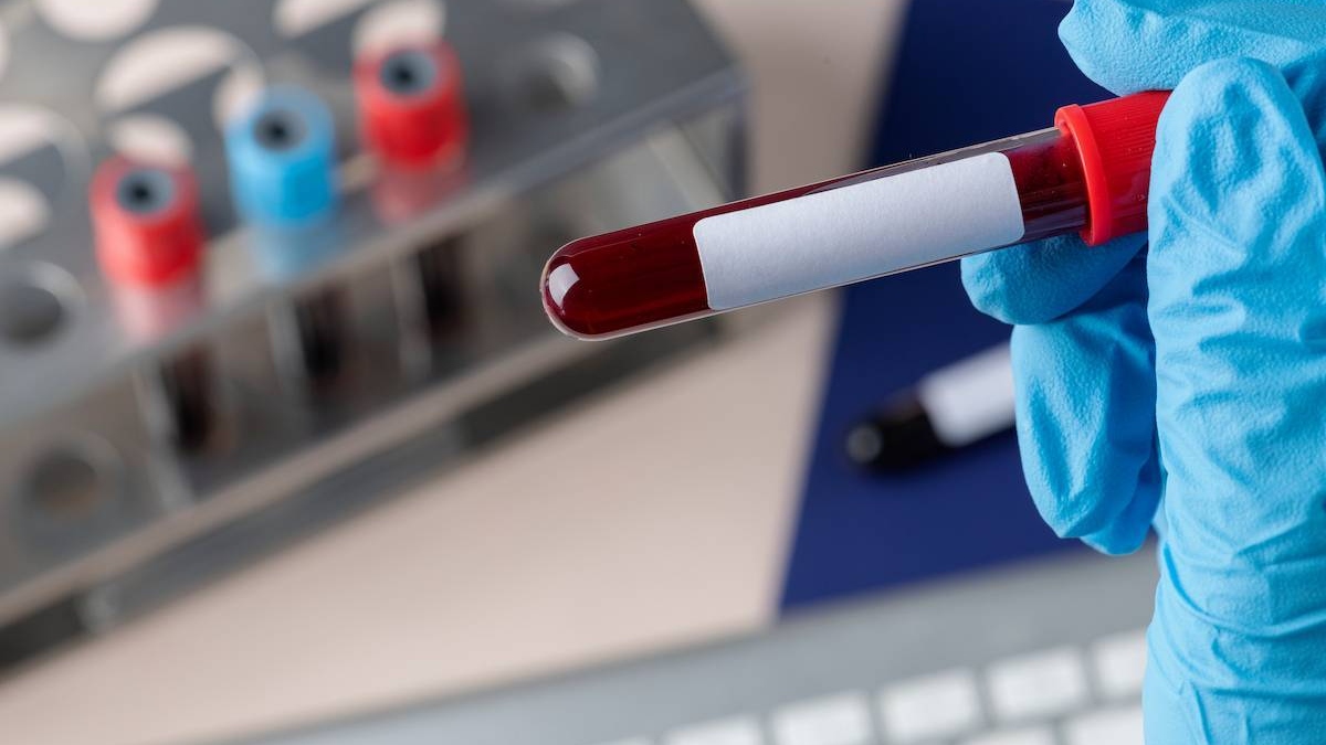 Un análisis genético de sangre para una detección precoz del párkinson