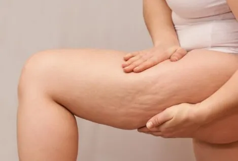 Celulitis: los tratamientos que sí funcionan, según tres expertas en estética y belleza
