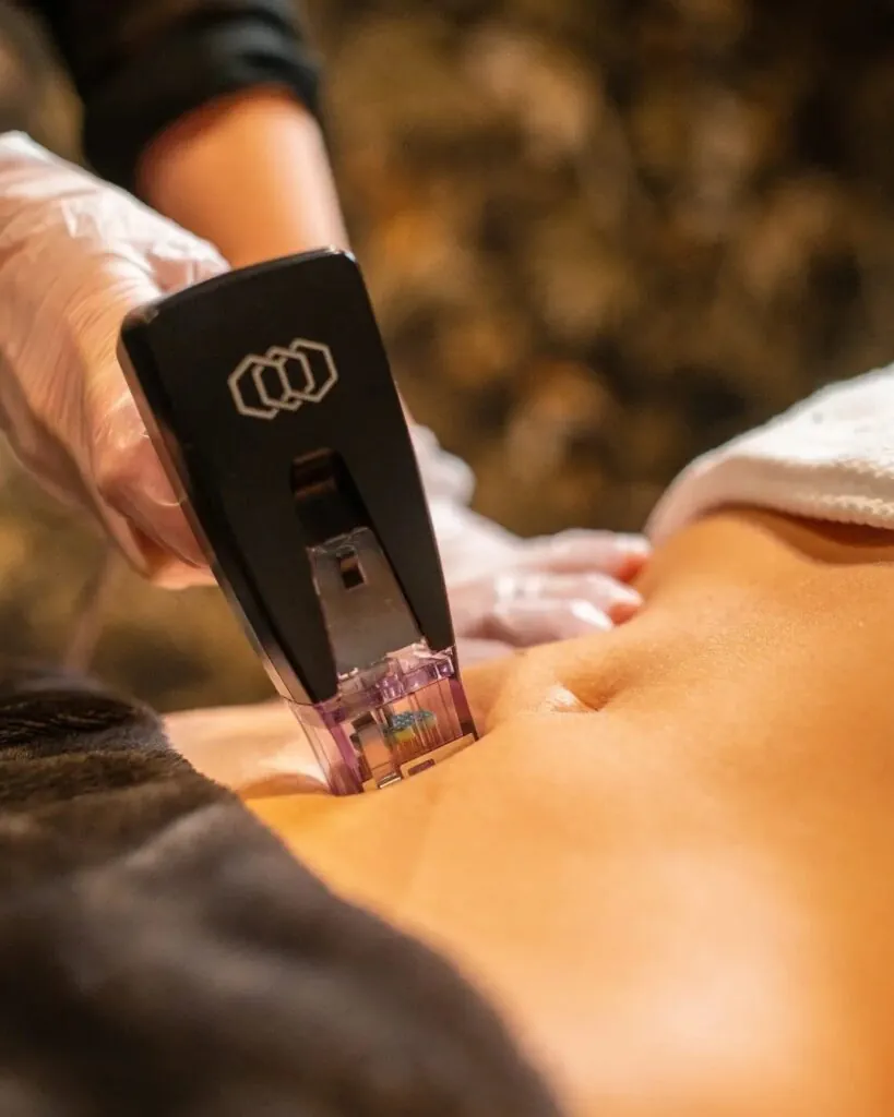 Aplicación de Morpheus 8 Body en la zona del abdomen. (Fuente: EVO Beauty Clinics)