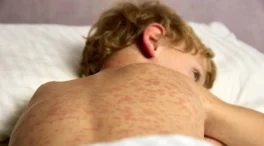 La OMS advierte de un aumento de casos de sarampión pese a una reducción de las muertes