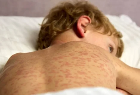 La OMS advierte de un aumento de casos de sarampión pese a una reducción de las muertes