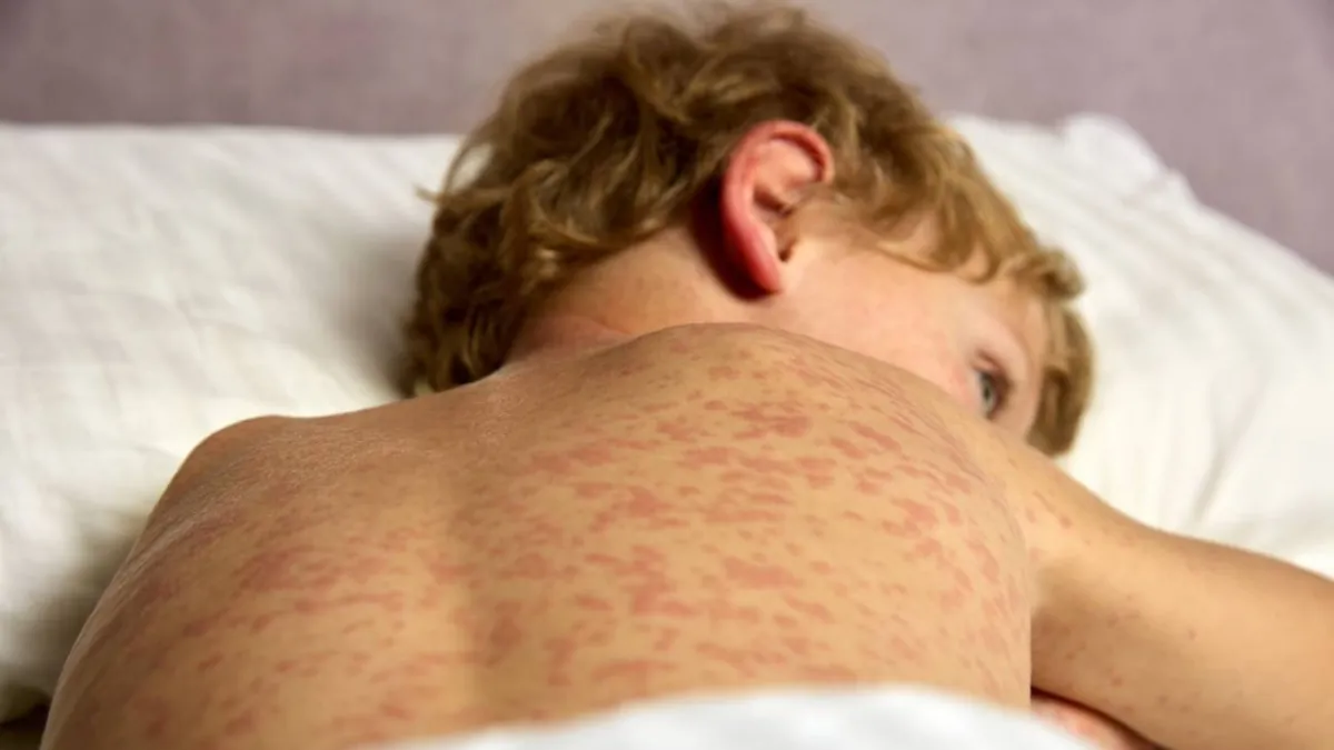 La OMS advierte de un aumento de casos de sarampión pese a una reducción de las muertes