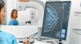 Una densidad mamográfica alta podría estar asociada con tumores de peor pronóstico