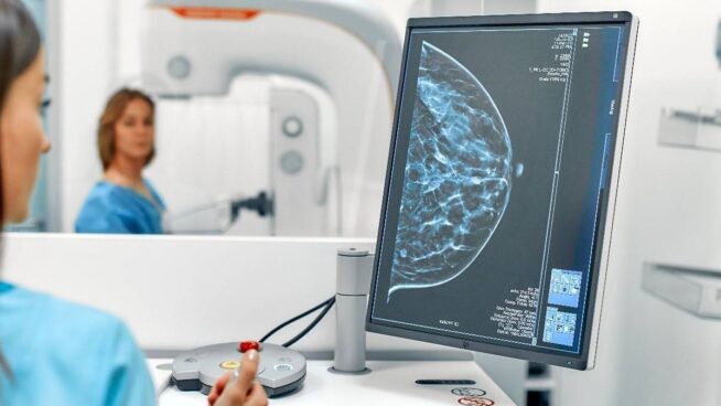 Una densidad mamográfica alta podría estar asociada con tumores de peor pronóstico