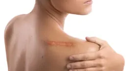 Borrando cicatrices: los sistemas más infalibles para reducir su aspecto lo máximo posible