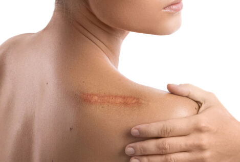 Borrando cicatrices: los sistemas más infalibles para reducir su aspecto lo máximo posible