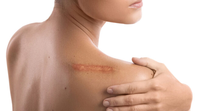 Borrando cicatrices: los sistemas más infalibles para reducir su aspecto lo máximo posible