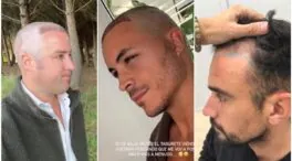 Las operaciones capilares y los famosos: IlloJuan y López Huerta ponen el pelo de moda