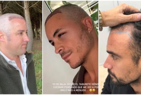 Las operaciones capilares y los famosos: IlloJuan y López Huerta ponen el pelo de moda